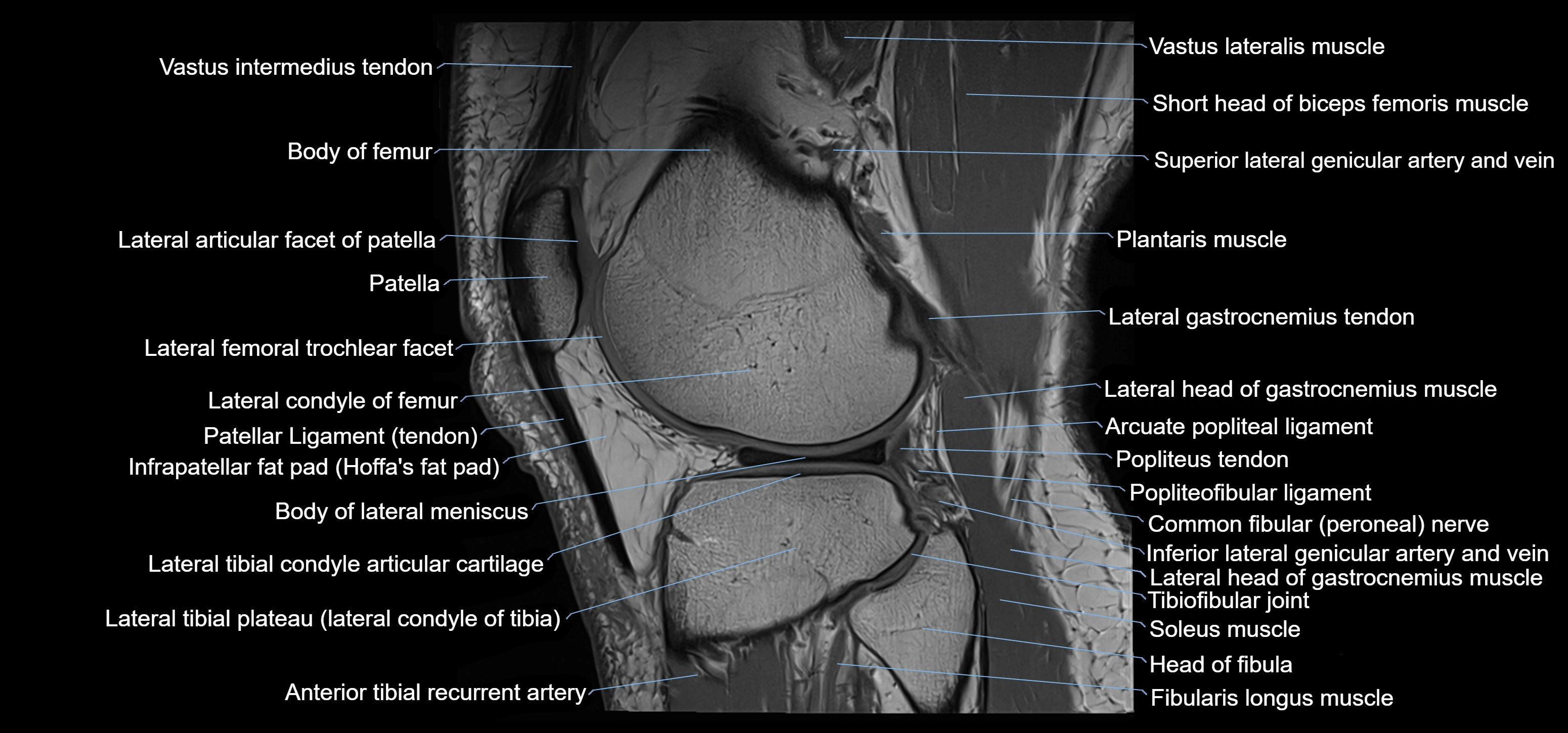 MRI knee sagittal cross sectional anatomy labelled 3T radiology image-00037.webp